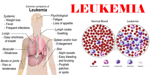 Leukemia or Blood Cancer | Health On Life