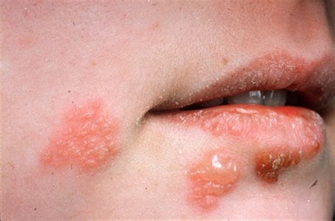 Herpes – Symptoms, Causes & Treatments - SAFE HEALTH LIFE