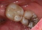 Amalgam | Dr. Andrea Stevens Dentistry