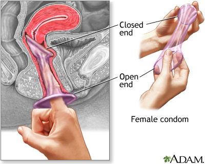Female condoms - Penn State Hershey Medical Center