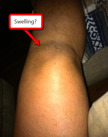Swollen Knee - Causes, Symptoms, Treatment, No Pain ...