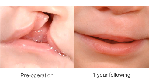 Cleft Lip and Palate Treatment | Treatment for Cleft Lip ...
