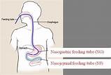 Nasoduodenal (ND) Tubes