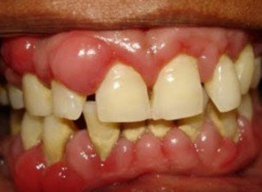 Lump on Gum Causes, Hard, Painful, White, Bump, above ...