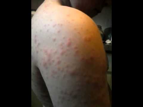 Allergic reaction to Amoxicillin - YouTube