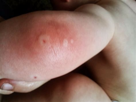 Bee Sting Swelling - Treatment, Pictures, Home Remedies