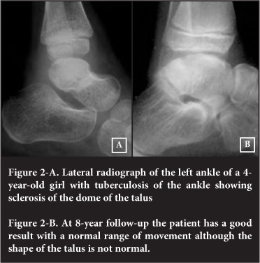 Tuberculosis of the foot and ankle in children