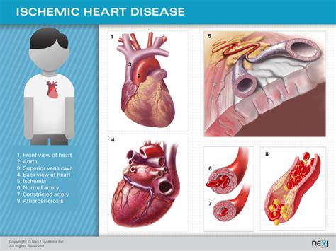 Patient Education | Cardiovascular System | NexJ Health