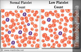 Rheumatoid Arthritis And Low Blood Platelets Count ...