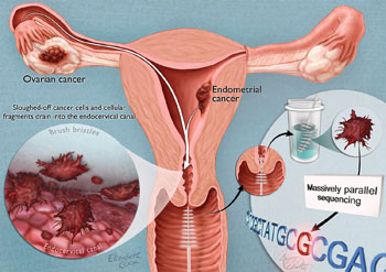 Science Translational Medicine : A Pap Smear for Ovarian ...